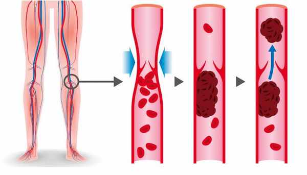 Лечение тромбоза
