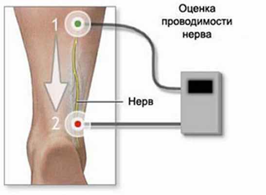 Диагностика уровня повреждения нерва при диабетической, алкогольной и токсической полиневропатии нижних конечностей производится при помощи электронейрографии (ЭНГ).