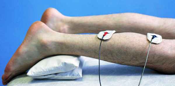 Нейростимуляция посредством СМТ (физиотерапия) ускоряет устранение парестезии и боли, восстанавливает силу в мышцах ног при лечении алкогольного полиневрита (полиневропатии) и диабетической невропатии нижних конечностей.