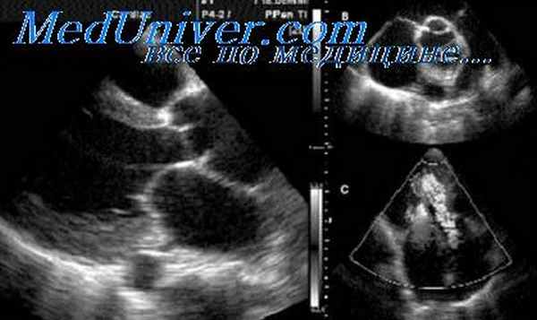 нейроциркуляторная дистония