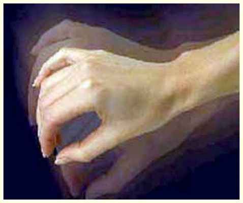 Дрожание (тремор) рук и головы: постуральный, интенционный.