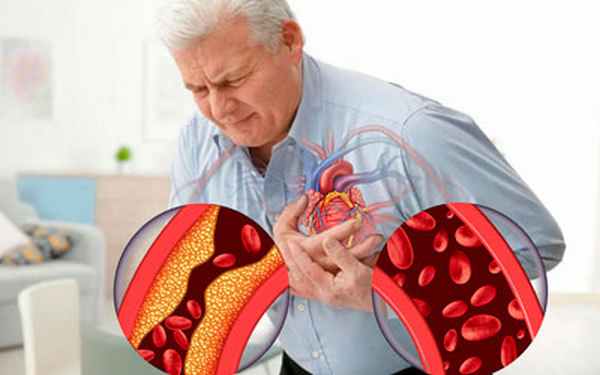 Стойкая ишемия периферической нервной системы - Угодие