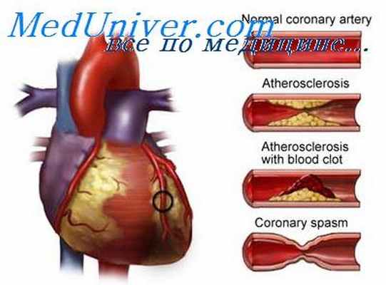 ожирение миокарда