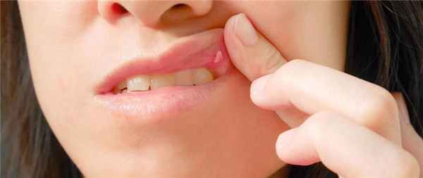 язвы при стоматите