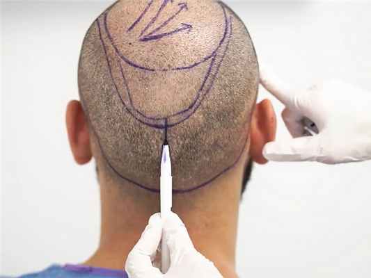 Лечение алопеции 