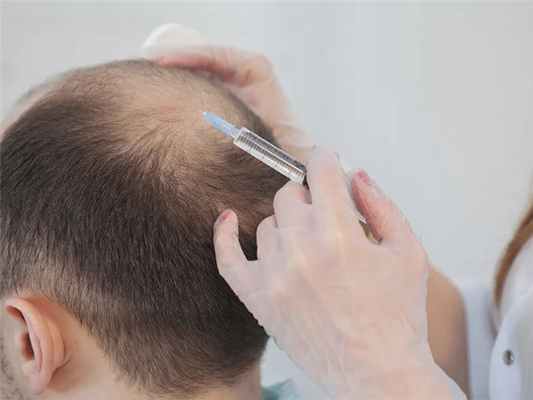 Лечение алопеции 