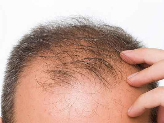 Лечение алопеции 