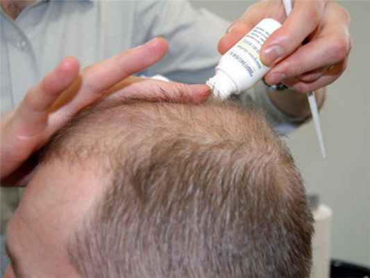 Лечение алопеции 
