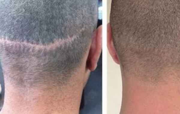 рубцовая алопеция.jpg