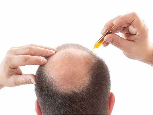 Лечение алопеции 