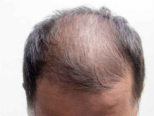 Лечение алопеции 