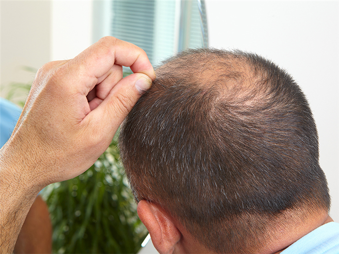 Лечение алопеции