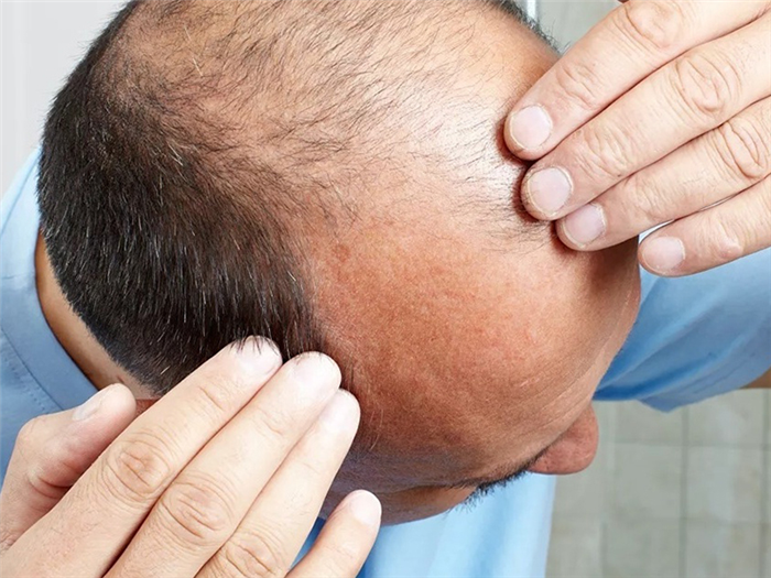 Лечение алопеции