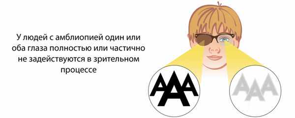 амблиопия ленивый глаз