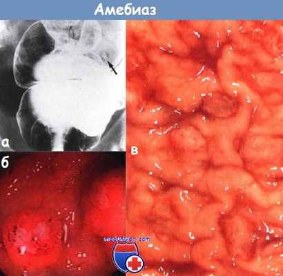 Амебный колит - амебиаз
