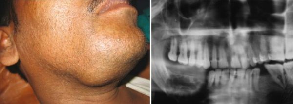 Амелобластома [11]