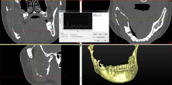 КТ свидетельствует об объемном образовании нижней челюсти