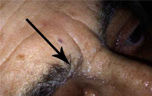 Анальгетическая нефропатия