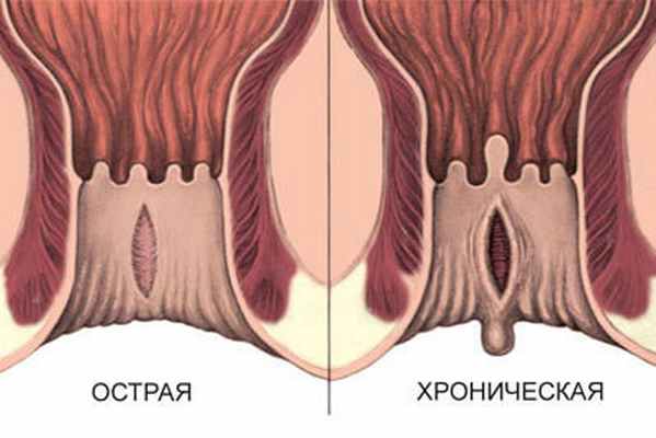типы анальных трещин схема