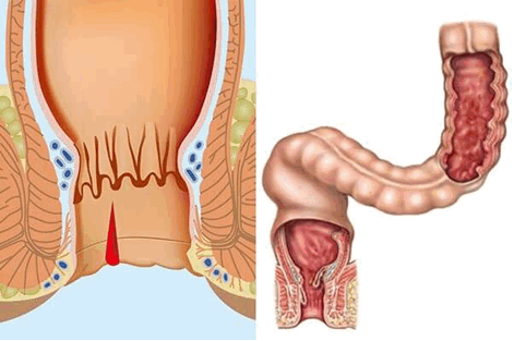 Анальные трещины методы лечения