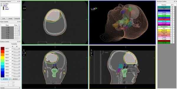 Астроцитома головного мозга - план лечения на линейном ускорителе, с распределением доз облучения для различных типов биологических тканей