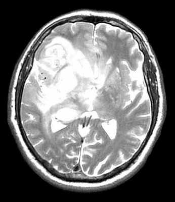глиобластома-Т2