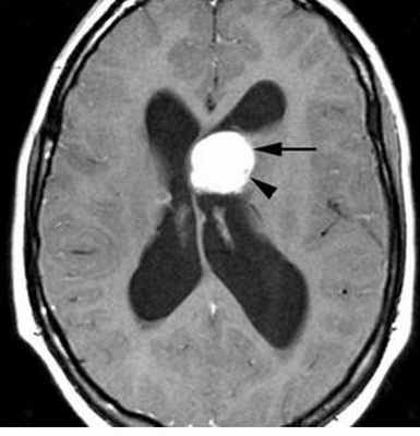 тубер скл-Т1-контр