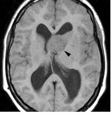 тубер скл-Т1