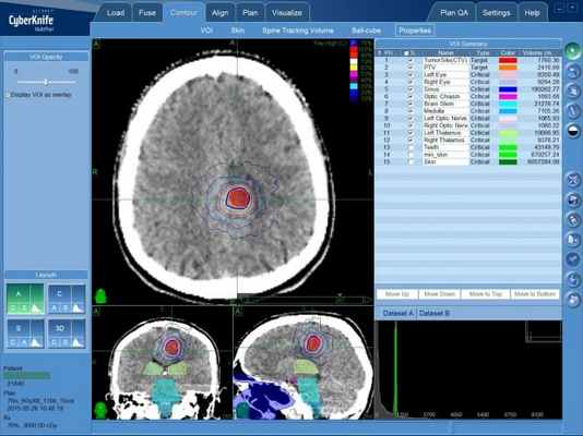 Безоперационное лечение астроцитомы — КиберНожом