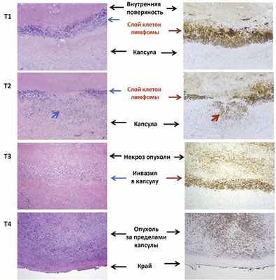 Анапластическая крупноклеточная лимфома. Cимптомы и прогноз лечения