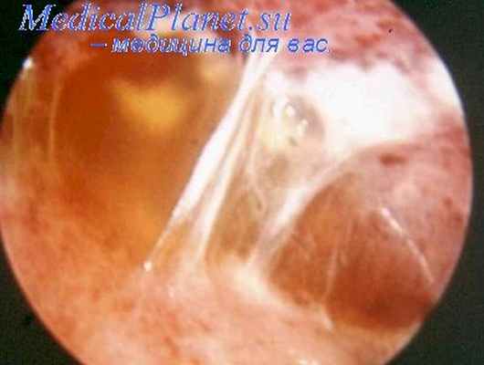 операция на диафрагмальном нерве