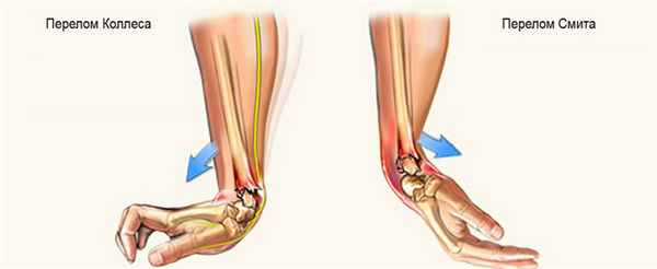 виды переломов лучевой кости