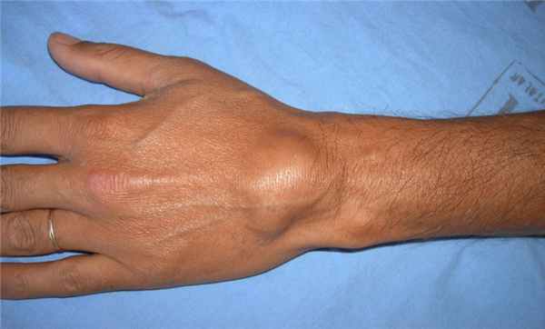 гигрома лучезапястного сустава