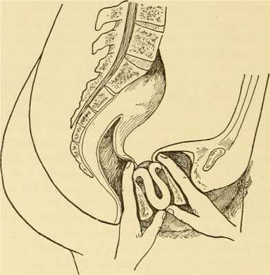 Что это - просак у женщин?