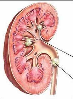 Причины и симптомы проявления камней в мочеточнике