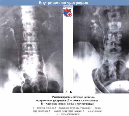 Анатомия: Лучевая анатомия почки (рентгенанатомия почки)