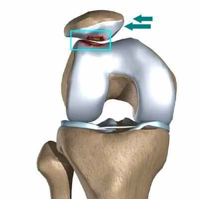 вывихи чашечки коленного сустава 