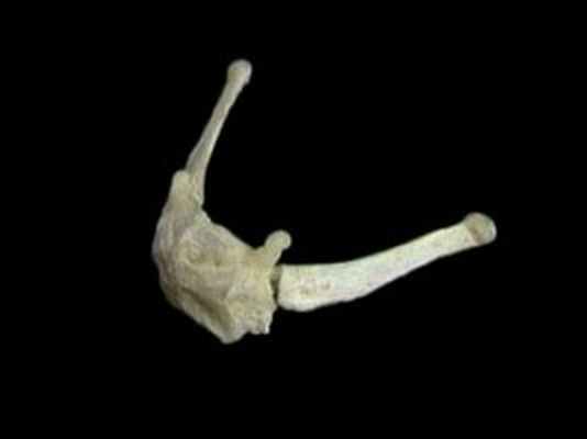 перелом подъязычной кости 