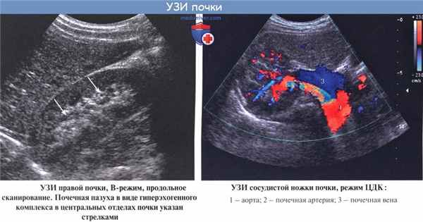 Анатомия: Лучевая анатомия почки (рентгенанатомия почки)