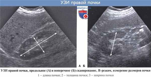 Анатомия: Лучевая анатомия почки (рентгенанатомия почки)