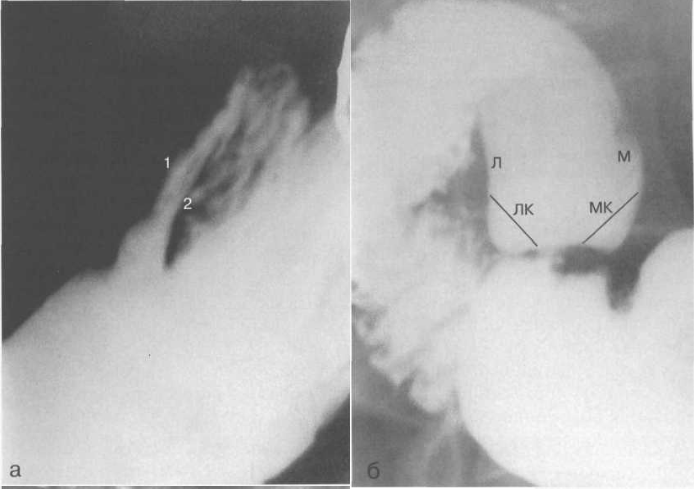 Рентгенограммы луковицы двенадцатиперстной кишки.
