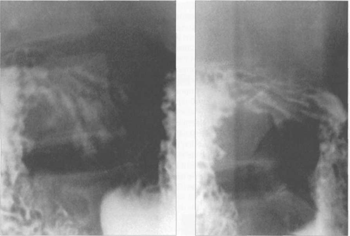 Рентгенограммы рельефа слизистой луковицы двенадцатиперстной кишки в правом косом положении