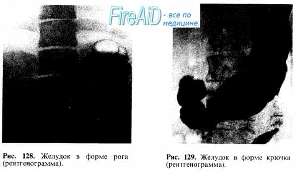 Рентгеноанатомия желудка.