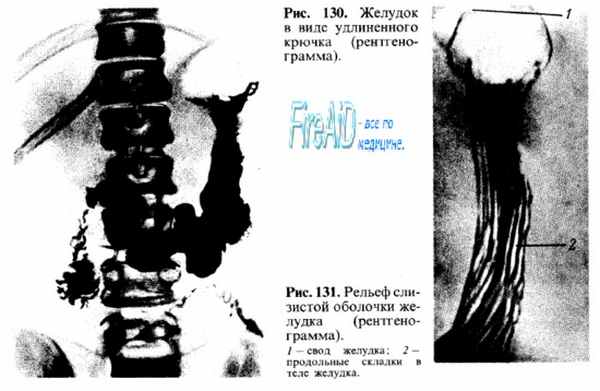 Рентгеноанатомия желудка.