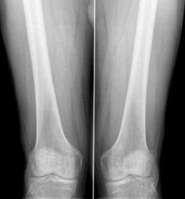 ветвь седалищной кости