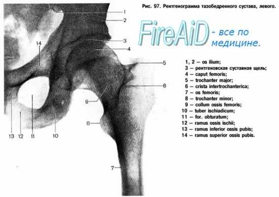 Тазобедренный сустав