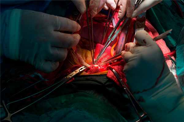 Аневризма аорты