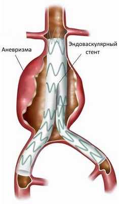 Эндоваскулярный стент