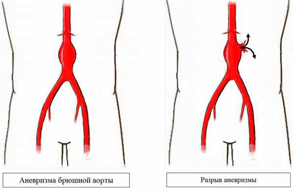 Аневризма брюшной аорты и её разрыв
