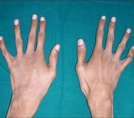 Фото Аневризма грудной аорты 